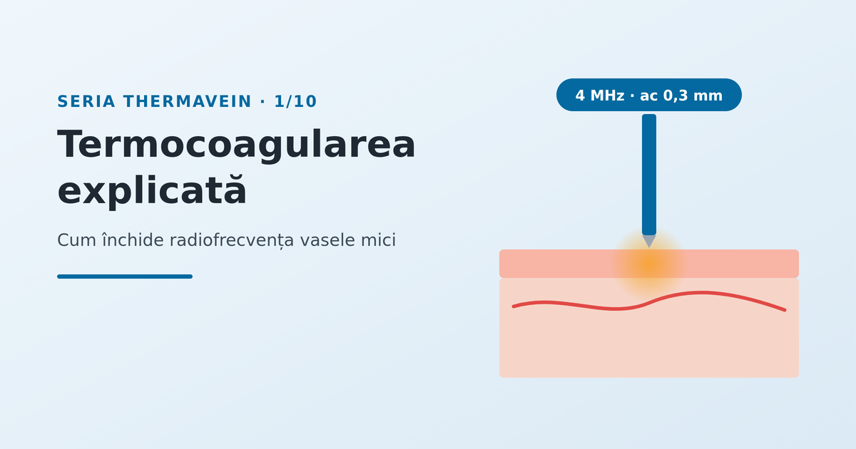 Termocoagularea explicată: cum închide radiofrecvența vasele mici - imagine reprezentativă