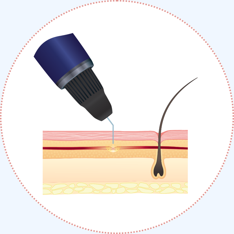 Step 1: the insulated ThermaVein probe applied to the skin surface above the vessel