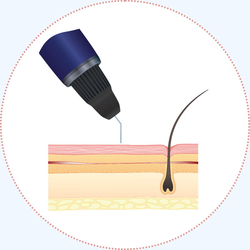 Step 3: the sealed vessel is absorbed by the body and the skin returns to its normal appearance