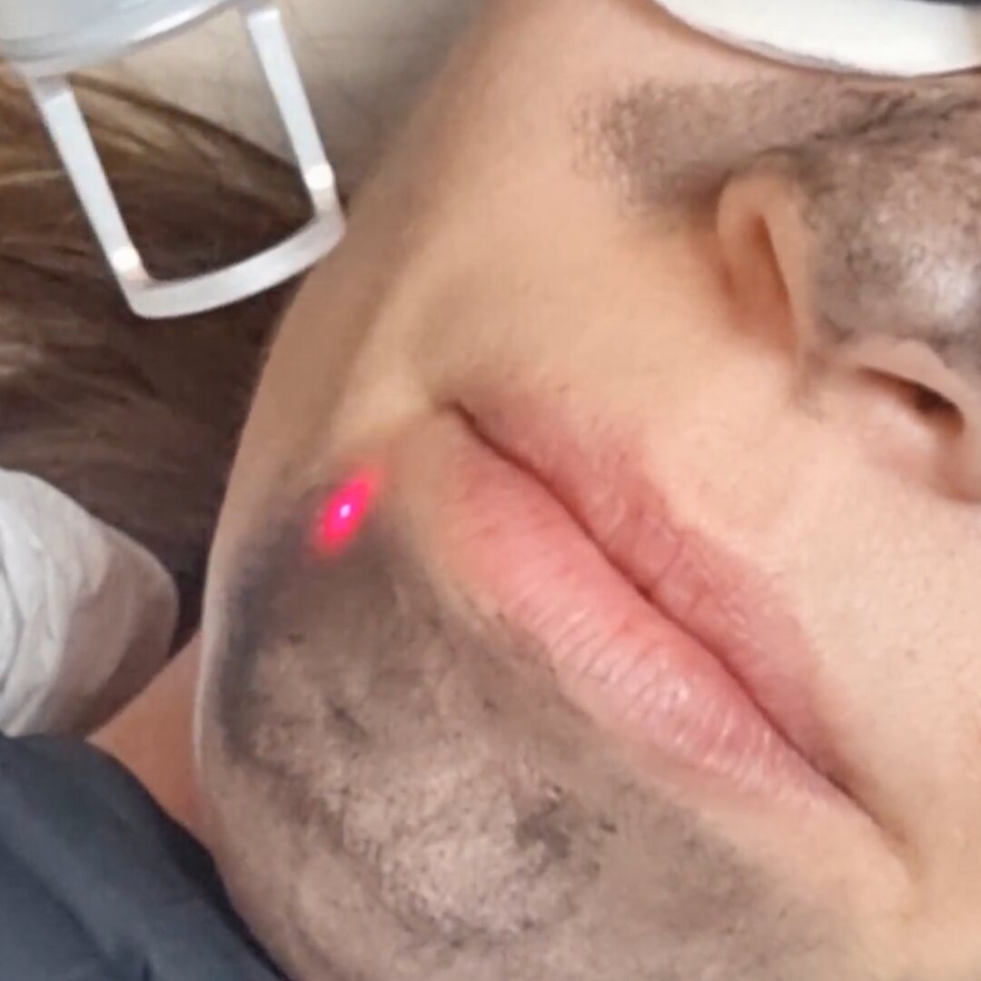 FINEBEAM Dual: carbon peel