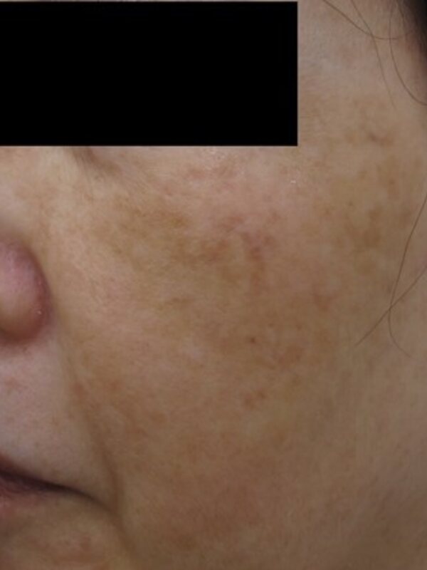 Melasmă și eritem facial, După