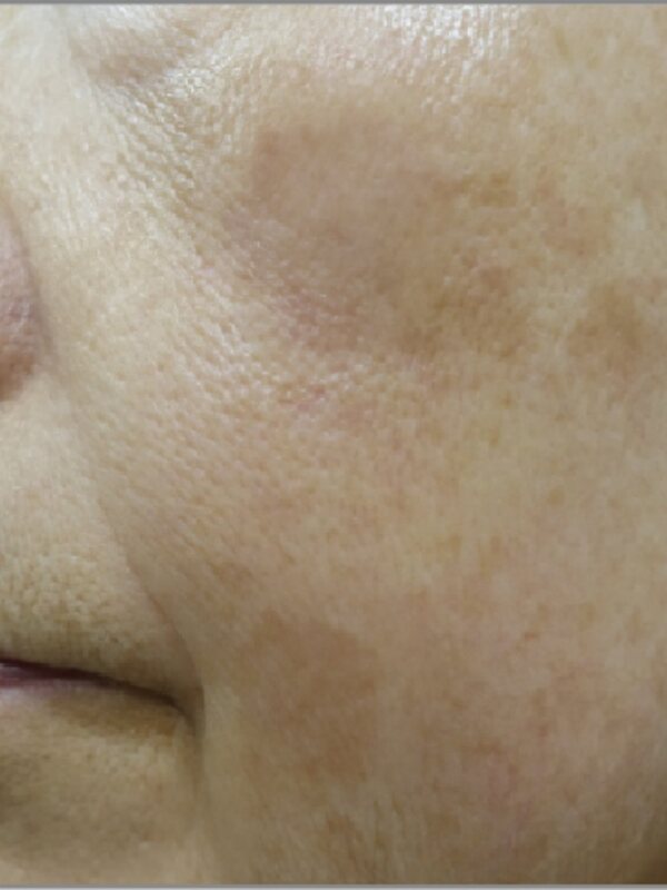 FINEBEAM: melasma, after