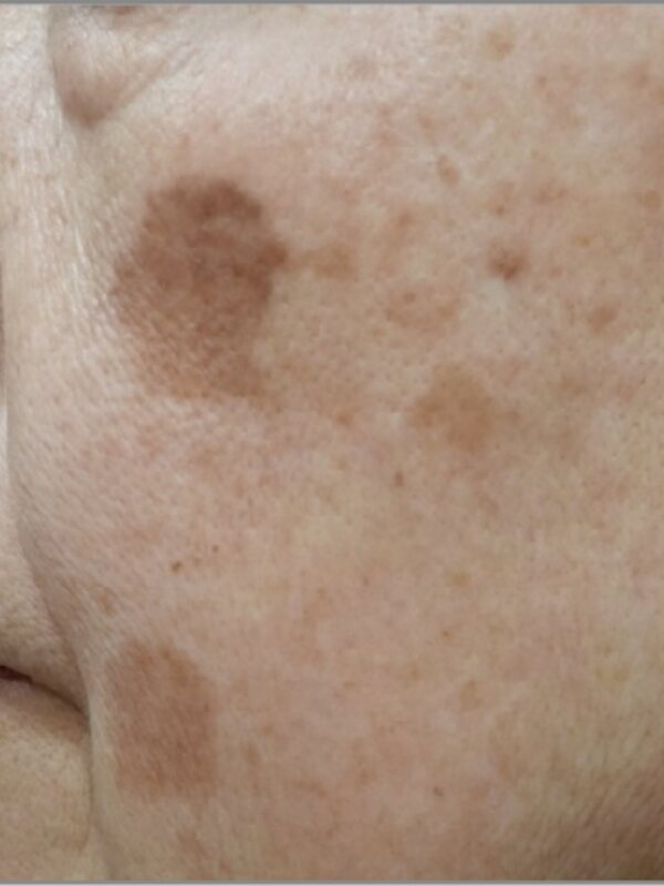 FINEBEAM: melasma, before