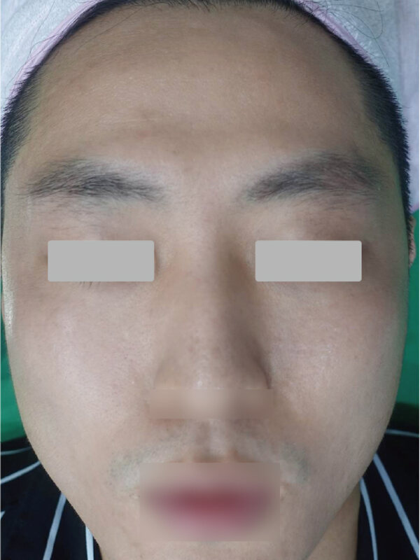 FINEXEL: acne scars, after