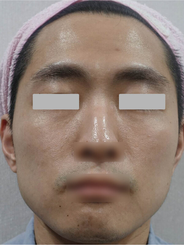 FINEXEL: acne scars, before