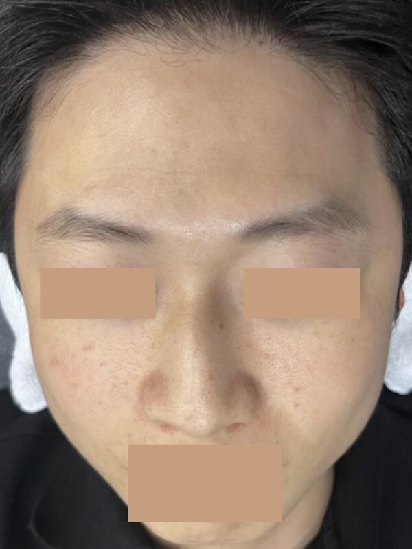 FINEXEL Fresh Peel, before