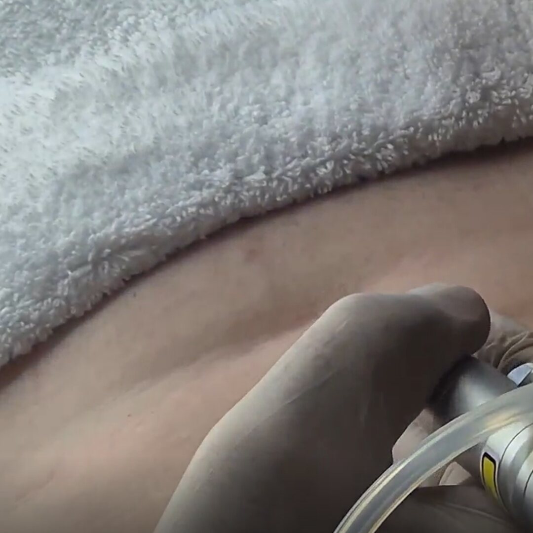 FINEXEL CO₂: surgical use