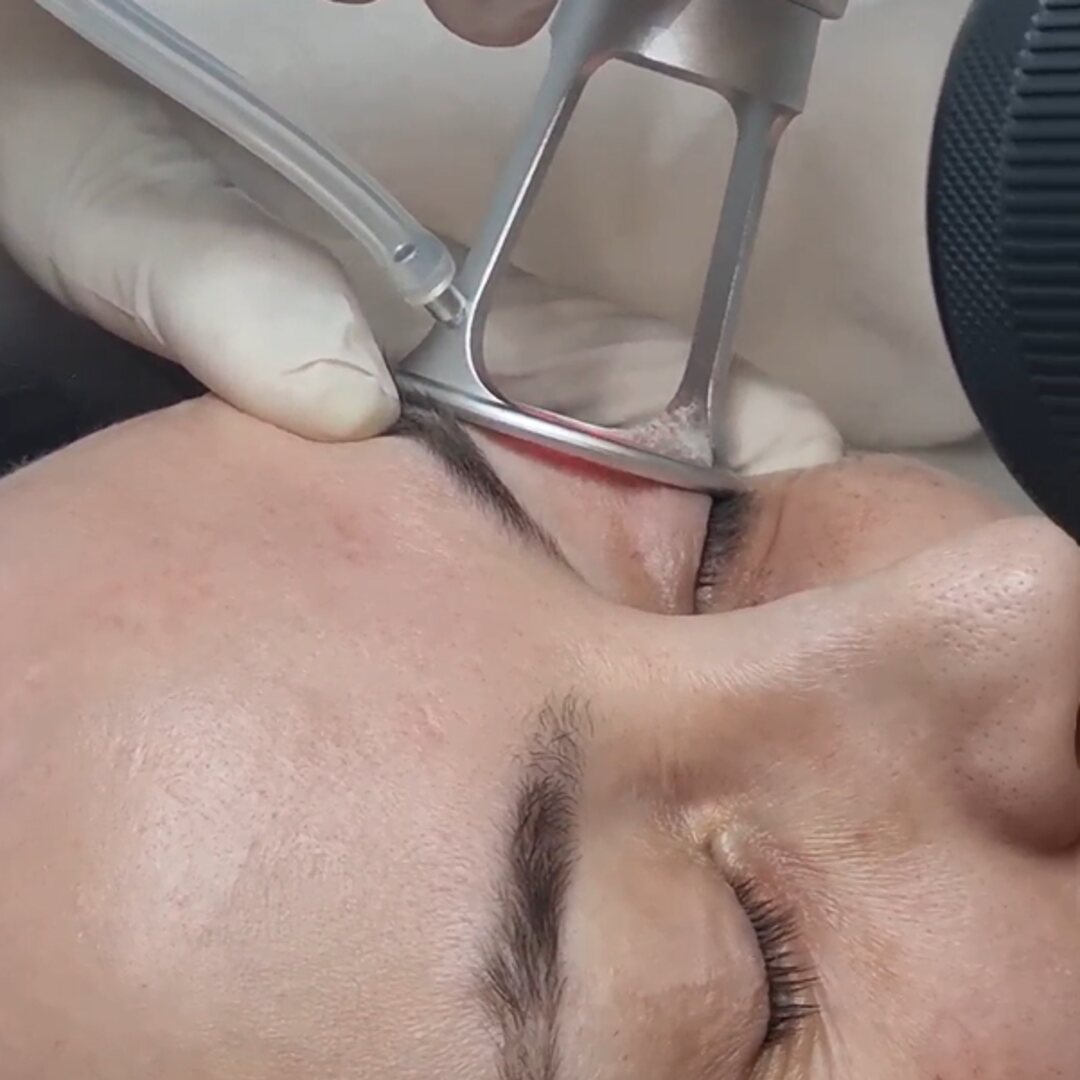 FINEXEL CO₂: periorbital area