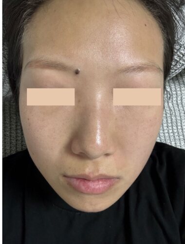 Comparație split-face: Fresh Peel (Smart Scatter) pe stânga, CO₂ standard pe dreapta, 24 de ore