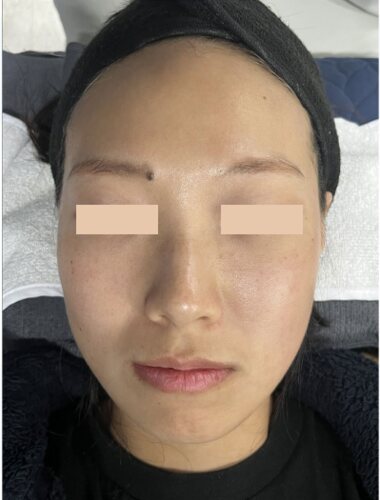 Comparație split-face: Fresh Peel (Smart Scatter) pe stânga, CO₂ standard pe dreapta, 3 ore