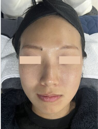 Comparație split-face: Fresh Peel (Smart Scatter) pe stânga, CO₂ standard pe dreapta, 6 ore