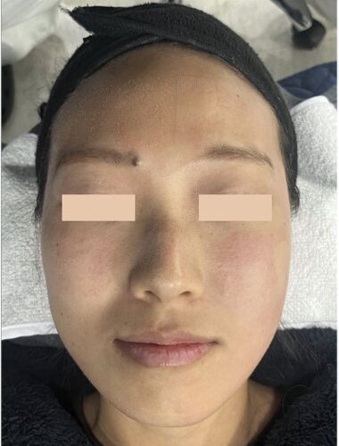 Comparație split-face: Fresh Peel (Smart Scatter) pe stânga, CO₂ standard pe dreapta, Imediat după