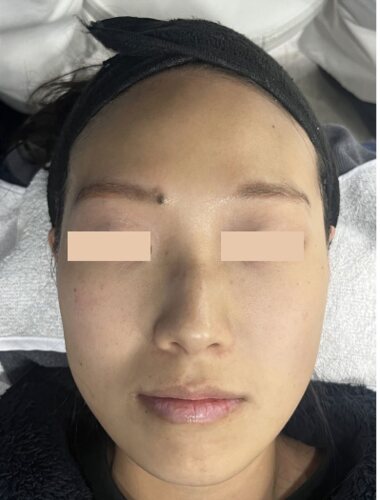 Comparație split-face: Fresh Peel (Smart Scatter) pe stânga, CO₂ standard pe dreapta, Înainte