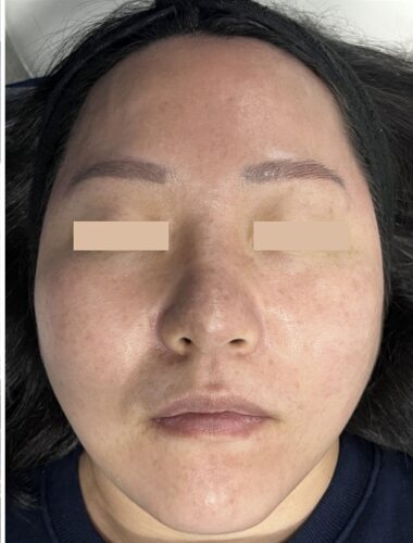 Comparație split-face: Fresh Peel (Smart Scatter) pe stânga, CO₂ standard pe dreapta, 24 de ore