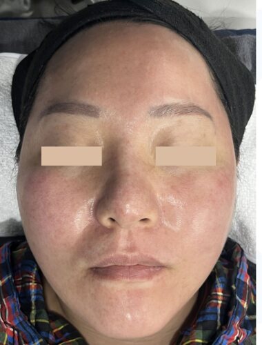 Comparație split-face: Fresh Peel (Smart Scatter) pe stânga, CO₂ standard pe dreapta, 3 ore