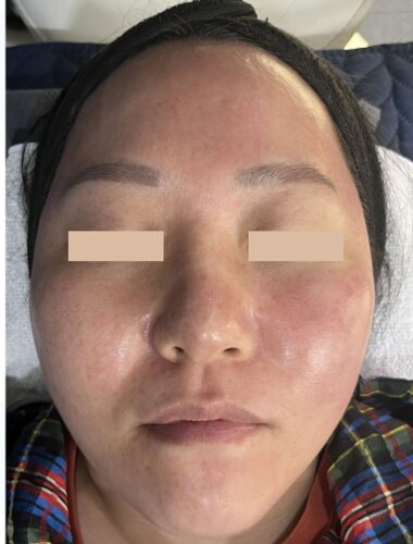 Comparație split-face: Fresh Peel (Smart Scatter) pe stânga, CO₂ standard pe dreapta, 6 ore