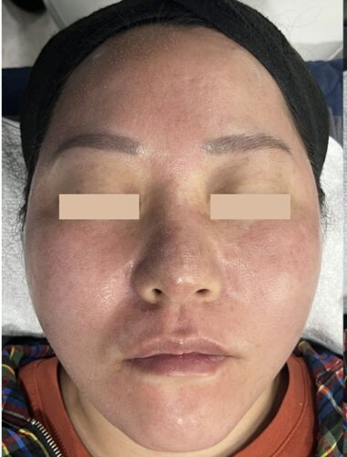 Comparație split-face: Fresh Peel (Smart Scatter) pe stânga, CO₂ standard pe dreapta, Imediat după