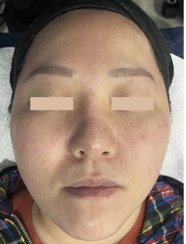Comparație split-face: Fresh Peel (Smart Scatter) pe stânga, CO₂ standard pe dreapta, Înainte