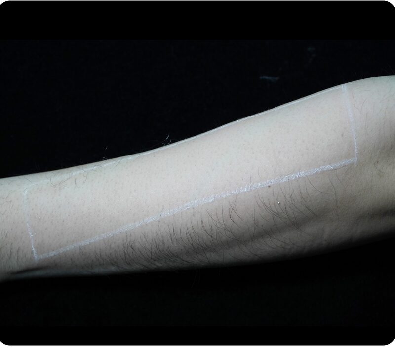 Laser hair removal, forearm, After