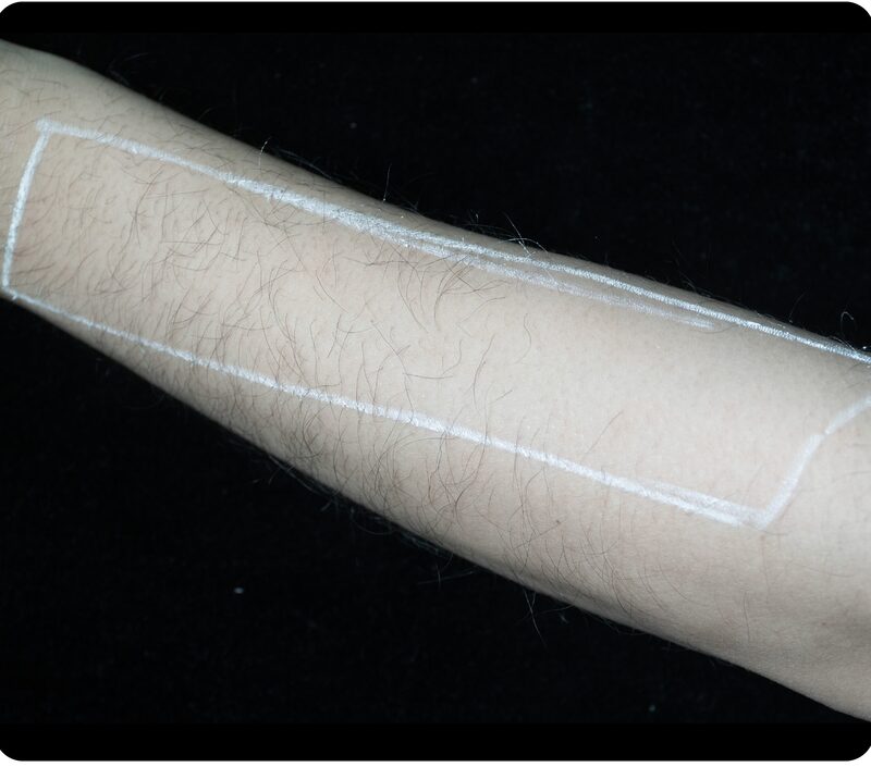 Laser hair removal, forearm, Before