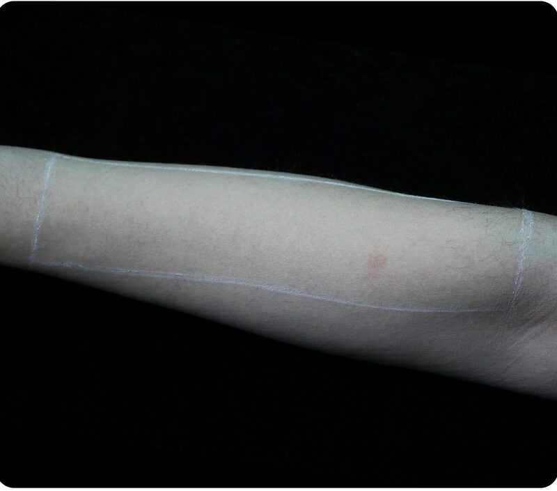 Laser hair removal, forearm, After