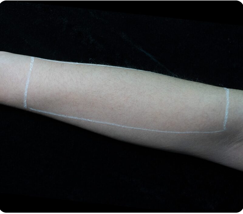 Laser hair removal, forearm, Before