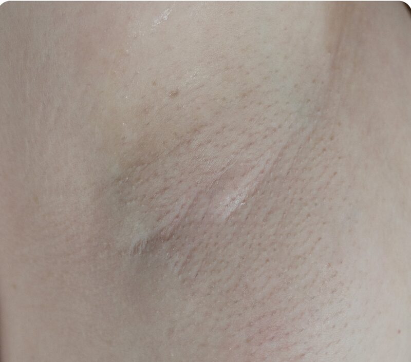 Laser hair removal, axilla, After