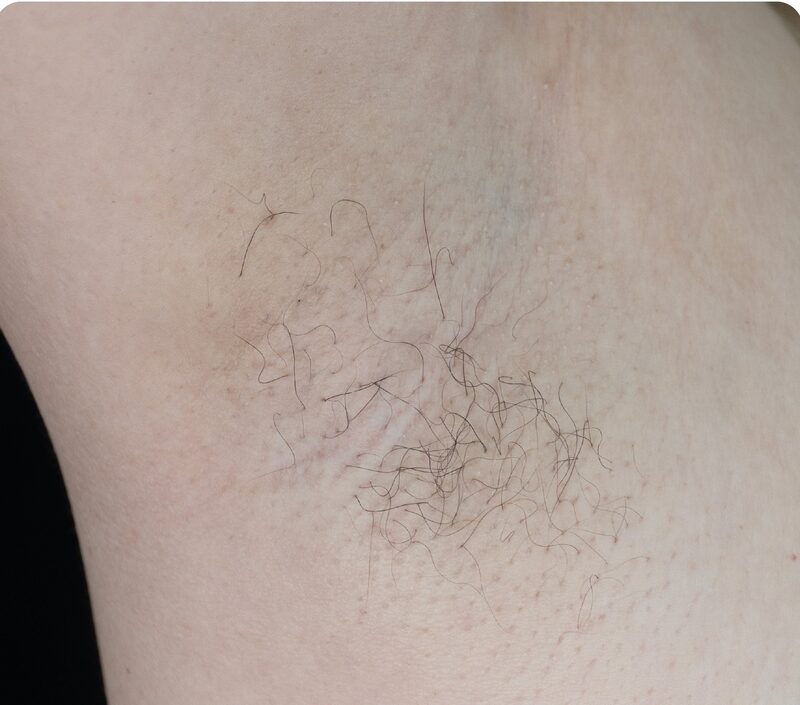 Laser hair removal, axilla, Before