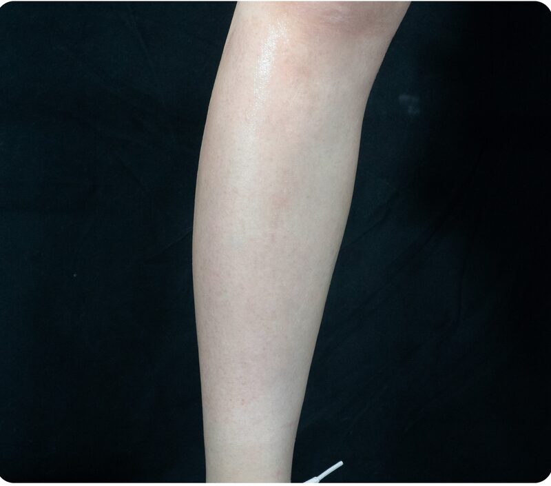 Laser hair removal, leg, After