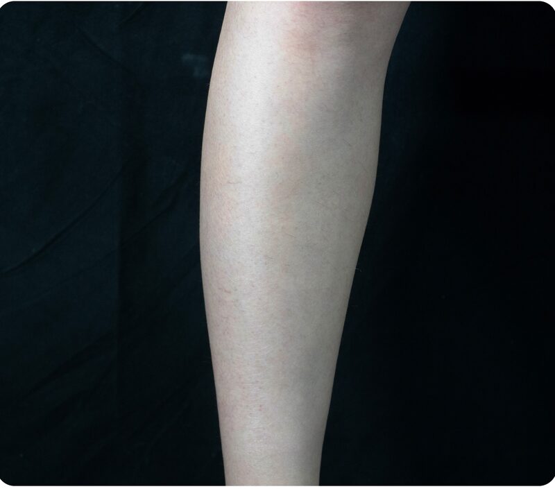 Laser hair removal, leg, Before