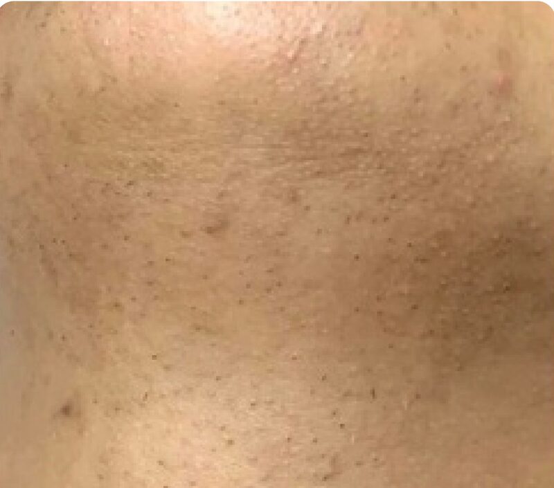 Laser hair removal, neck, After