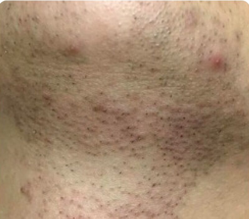 Laser hair removal, neck, Before
