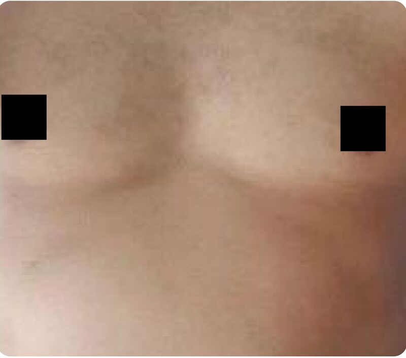 Laser hair removal, trunk, After