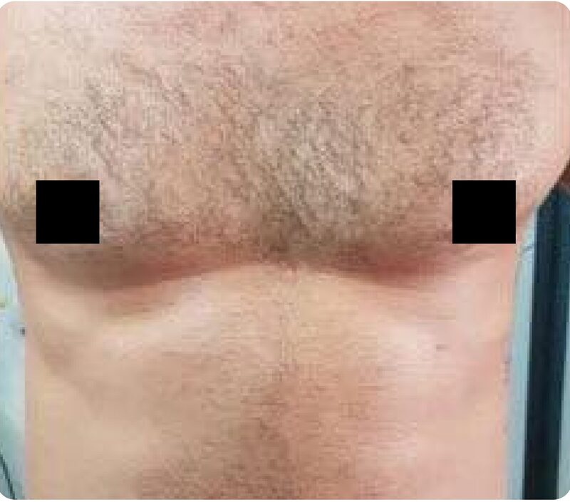 Laser hair removal, trunk, Before