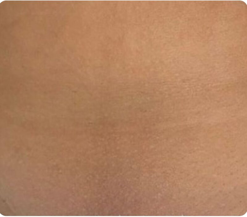 Laser hair removal, bikini area, After
