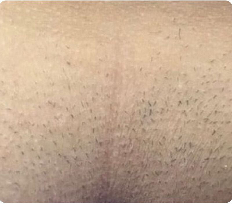 Laser hair removal, bikini area, Before